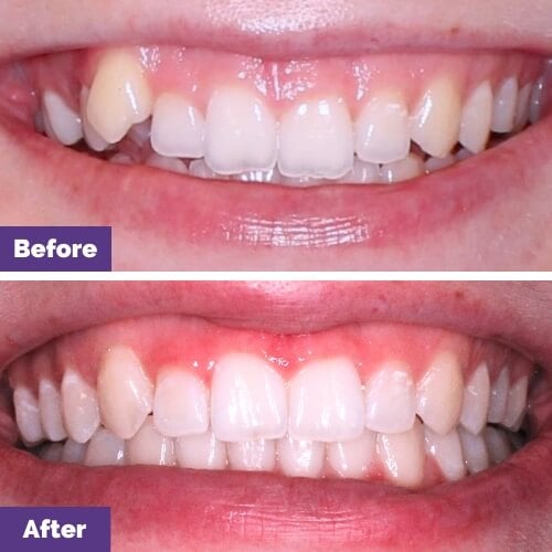 Invisalign Treatment