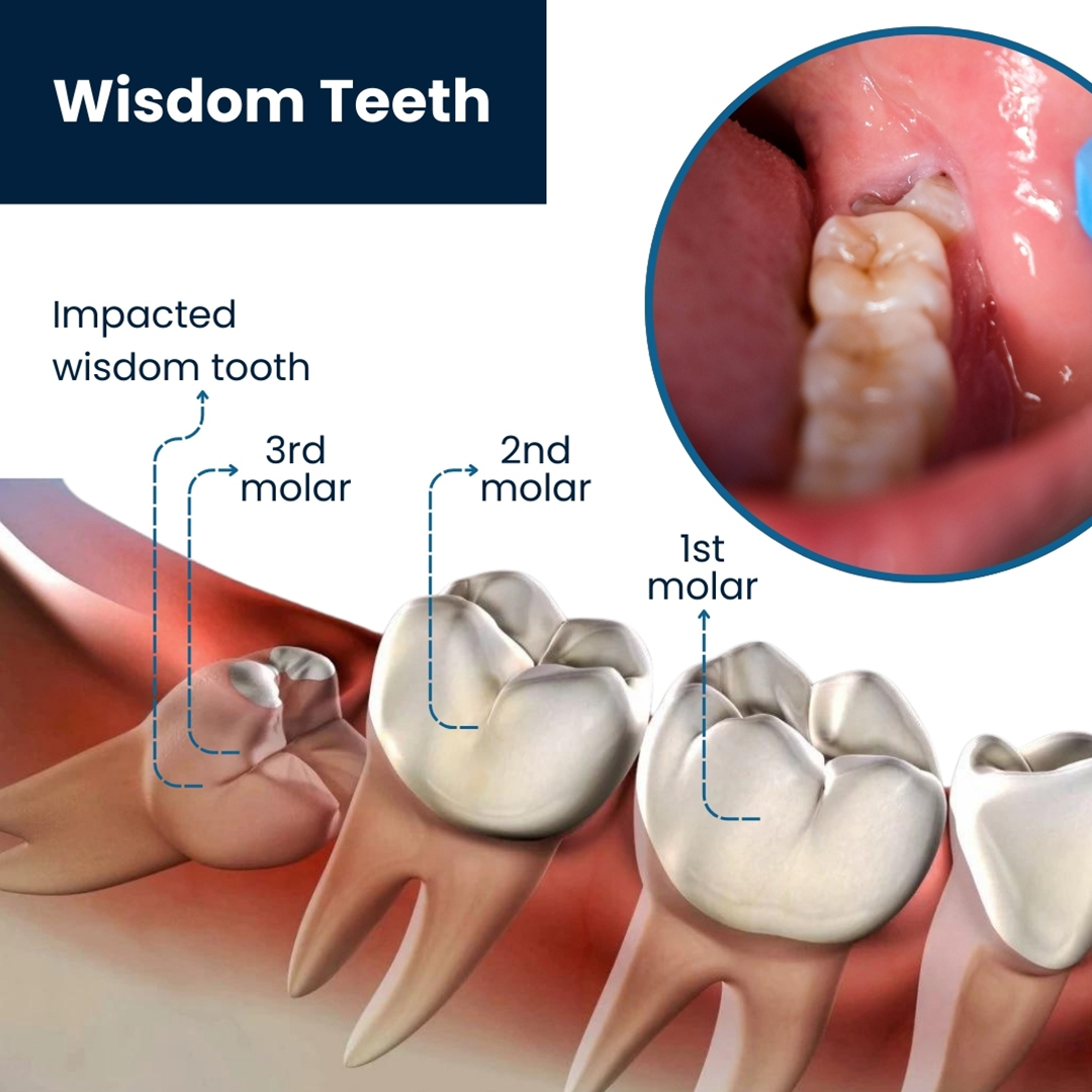 Wisdom Tooth Surgery